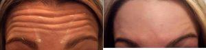 Doctor Todd Christopher Hobgood, MD, Phoenix Facial Plastic Surgeon - 28 Year Old Woman Treated With Botox For Forehead Wrinkles