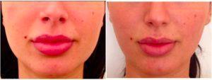 Doctor Todd Schlifstein, DO, New York Physician - Botox Before And After