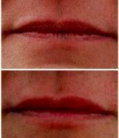 Doctor Vilma Di Maria, MBBS, Melbourne Physician - 51 Year Old Woman Treated With Juvederm