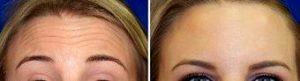 Doctor Vu Ho, MD, Plano Facial Plastic Surgeon - 20 Year Old Woman Treated With Botox