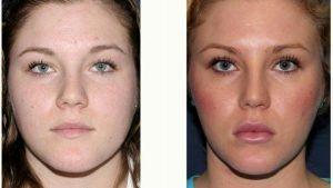 Doctor William Groff, DO, San Diego Dermatologist - 25 Year Old Woman Treated With Botox For Jaw Clenching And Teeth Grinding Before And After