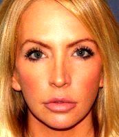 Doctor William Groff, DO, San Diego Dermatologist - 34 Year Old Woman Treated With Botox