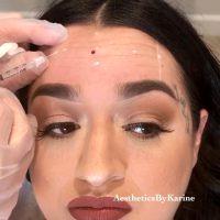 Does Botox Prevent Or Get Rid Of Forehead Lines