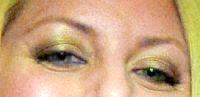 Does Botox Work Between The Eyes