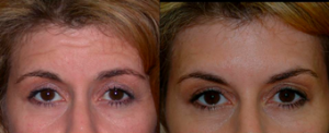 Dr A. John Vartanian, MD, Glendale Facial Plastic Surgeon - Botox Before And After