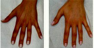 Dr Alex Eshaghian, MD, PhD, Encino Physician - 31 Year Old Woman Treated With Juvederm For The Hands