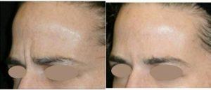 Dr Alex Eshaghian, MD, PhD, Encino Physician - 35 Year Old Woman Treated With Botox And Restylane 219
