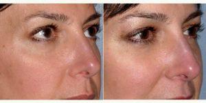 Dr Amit Bhrany, MD, Seattle Facial Plastic Surgeon - Facial Filler To Lower Eyelid And Cheek Before & After