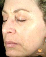 Dr Amy Forman Taub, MD, Chicago Dermatologic Surgeon - Patient Treated With BOTOX Cosmetic And Restylane