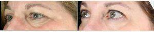 Dr Amy Forman Taub, MD, Chicago Dermatologic Surgeon - Woman Treated With Restylane