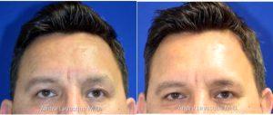 Dr Andre Levesque, MD, Austin Plastic Surgeon - 54 Year Old Man Treated With Botox