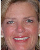 Dr Anna Petropoulos, MD, FRCS, Boston Facial Plastic Surgeon - Botox