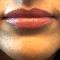 Dr Arianna Sholes-Douglas, MD, Tucson OB-GYN - 30 Year Old Woman Treated With Juvederm