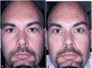 Dr Arnold W. Klein, MD , Beverly Hills Dermatologic Surgeon - Tear Grooves Filler-restylane