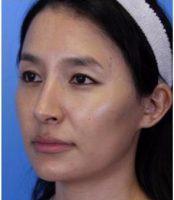 Dr Ava Shamban, MD, Santa Monica Dermatologic Surgeon - Cheekbones Enhanced With Botox