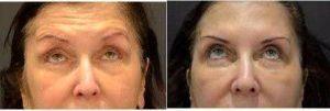 Dr B. Aviva Preminger, MD, New York Plastic Surgeon - 64 Year Old Woman Treated With Botox
