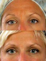 Dr Brett S. Kotlus, MD, MS, New York Oculoplastic Surgeon - Botox For Frown Lines And Crow's Feet