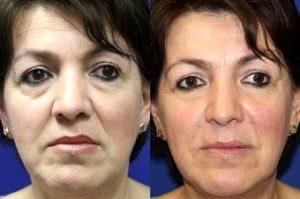 Dr Clay Forsberg, MD, Scottsdale Plastic Surgeon - 49yo, 2cc Juvederm To Nasolabial Folds And Marionette Lines