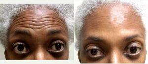 Dr Cylburn E. Soden Jr., MD, Laurel Dermatologic Surgeon - 64 Year Old Woman Treated With Botox For Forehead Lines