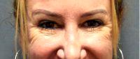 Dr Dana Goldberg, MD, Jupiter Plastic Surgeon - Botox For Woman To Crows Feet