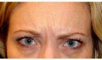 Dr Daniel Levy, MD, Bellevue Dermatologic Surgeon - 27 Year Old Woman Treated With Botox