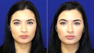 Dr Dilip D. Madnani, MD, FACS, New York Facial Plastic Surgeon - 18 Year Old Woman Treated With Restylane Before & After