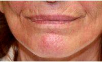 Dr Dilip D. Madnani, MD, FACS, New York Facial Plastic Surgeon - 68 Year Old Woman Treated With Botox And Belotero To Lines Around The Mouth