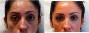 Dr Elham Jafari, MD, Irvine Physician - 42 Year Old Woman Treated With Restylane Under The Eyes