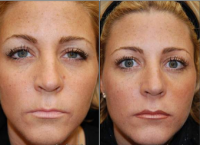 Dr Eric M. Joseph, MD, West Orange Facial Plastic Surgeon - Liquid Face Lift Injections With BOTOX Cosmetic And Silikon