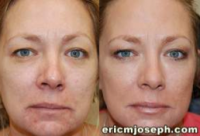 Dr Eric M. Joseph, MD, West Orange Facial Plastic Surgeon - Non-Surgical Facial Rejuvenation With BOTOX Cosmetic And Silikon