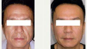 Dr Frances Jang, MD, Vancouver Dermatologic Surgeon - 54 Year Old Man Treated With Botox, HA Filler, Sculptra