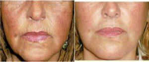 Dr Frances Jang, MD, Vancouver Dermatologic Surgeon - 62 Year Old Woman Treated With Botox And Dermal Filler In Face