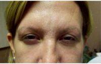 Dr Garry R. Lee, MD, Henderson Physician - 54 Year Old Woman Treated With Botox