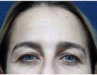 Dr Gary D. Breslow, MD, FACS, Paramus Plastic Surgeon - 41 Year Old Woman Treated With Botox