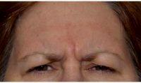 Dr Gary D. Breslow, MD, FACS, Paramus Plastic Surgeon - 56 Year Old Woman Treated With Botox