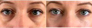 Dr Giancarlo Zuliani, MD, Rochester Facial Plastic Surgeon - 43 Year Old Woman Treated With Restylane For Undereye Hollows