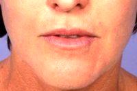 Dr Grant Stevens, MD, Los Angeles Plastic Surgeon - Botox And Juvederm Ultra Plus To Upper Lip