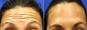 Dr Gregory Barron, MD, Stuart Dermatologic Surgeon - Botox For Forehead Wrinkles And Dysport