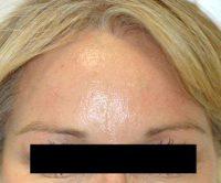 Dr Harold J. Kaplan, MD, Los Angeles Facial Plastic Surgeon - Dysport Injections Orange County And After