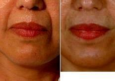 Dr Harold J. Kaplan, MD, Los Angeles Facial Plastic Surgeon - Restylane Injections For Laugh Lines