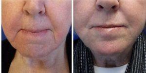 Dr Harry Goldin, MD, Skokie Dermatologist - 68 Year Old Woman Treated With Restylane