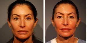 Dr Harry V. Wright, MD, Sarasota Facial Plastic Surgeon - 47 Year Old Woman Treated With Juvederm