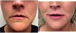 Dr J. Jason Wendel, MD, FACS, Nashville Plastic Surgeon - Juvederm Lip Fillers For This 46 Year Old Woman Before & After