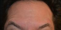 Dr Jason Emer, MD, Los Angeles Dermatologic Surgeon - 45 Year Old Male Treated For Forehead Lines