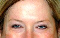 Dr Jennifer Parker Porter, MD, FACS, Bethesda Facial Plastic Surgeon - Botox Treatment Between Eyebrows