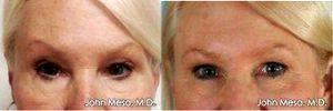 Dr John Mesa, MD, New York Plastic Surgeon - Reversing 'Surprised' Eyebrow Look By Lowering Eyebrows With BOTOX