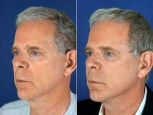 Dr Jonathan Kulbersh, MD, Charlotte Facial Plastic Surgeon - 63 Y.o. Male Liquid Facelift With Fillers