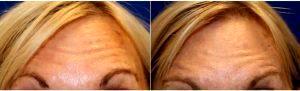Dr Jordan Cain, MD, Frisco Facial Plastic Surgeon - 68 Year Old Woman Treated With Botox To The Forehead Area Before And After