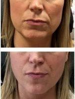 Dr Justin Harper, MD, Columbus Physician - 40 Year Old Woman Treated With Botox For Jawline