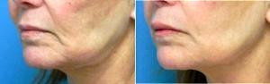 Dr Karol A. Gutowski, MD, FACS, Chicago Plastic Surgeon - Treated With Juvederm To The Upper And Lower Lips.